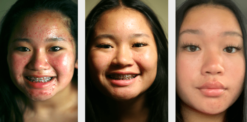 Acne teens adults hormonal breakouts pimples facials extractions before and after Woodlands Conroe