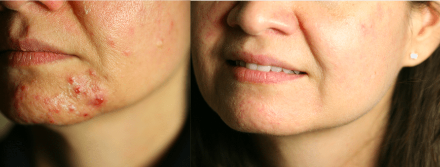 Acne adults hormonal breakouts pimples treatment facials products Conroe Woodlands