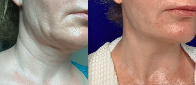Facial muscle toning laser tightening antiaging non-surgical Conroe Woodlands
