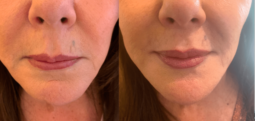Lips fillers Facial scars treatment procedure Juvederm Vobella Voluma Restylene Woodlands Conroe
