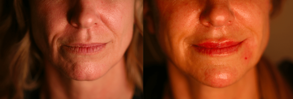 Lips fillers smiling lines Marionette chin filler Facial scars treatment procedure Juvederm Vobella Voluma Restylene Woodlands Conroe Spring
