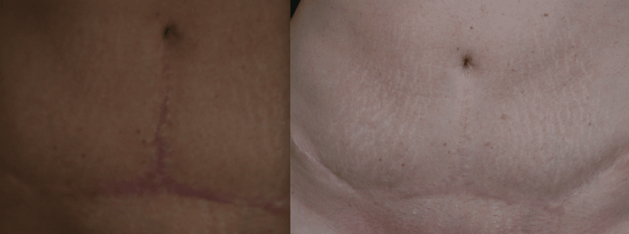 Microneedling scars collagen treatment Woodlands Conroe