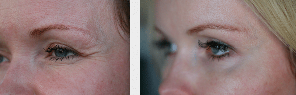 Microneedling natural treatment wrinkles antiaging Conroe Woodlands