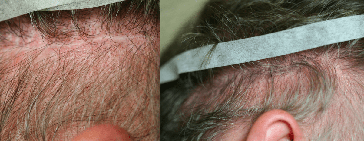 Plasma PRP PRF scalp boldiing hair loss regrow treatment antiaging collagen Conroe Woodlands scars